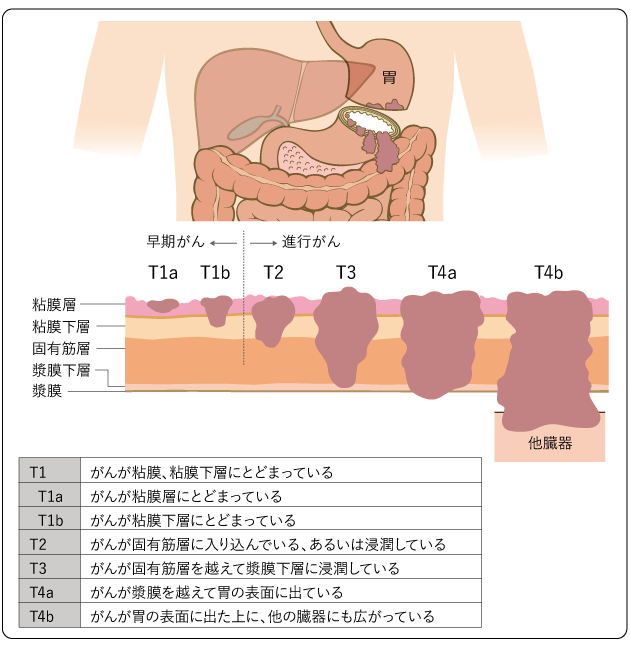 胃がんのTカテゴリー（深達度）